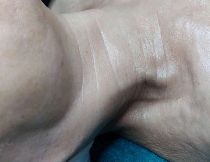 Hals- und Kinnpartie nach der Intra-Skin-Behandlung