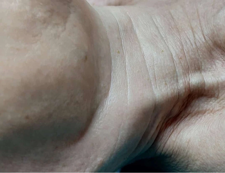 Hals- und Kinnpartie vor der Intra-Skin-Behandlung