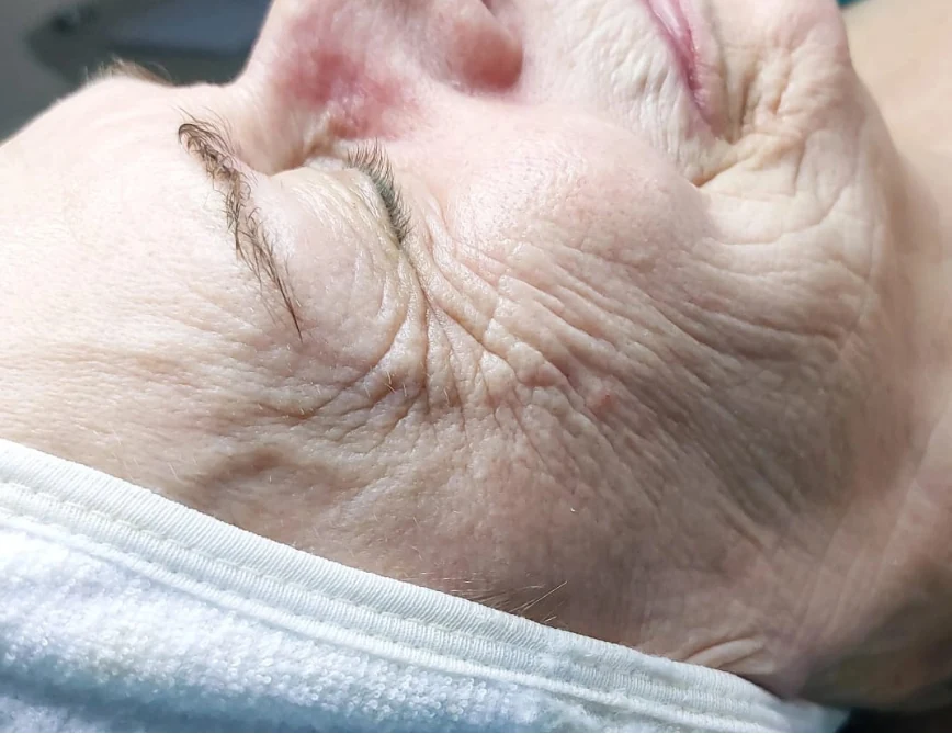Augen- und Wangenpartie vor der Intra-Skin-Behandlung