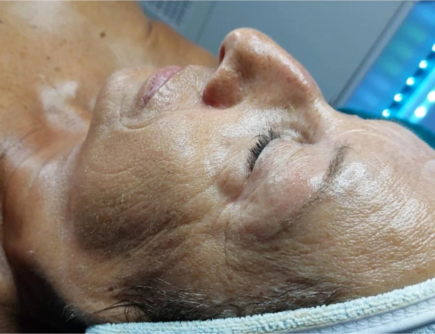 Seitliches Gesichtsprofil nach der Intra-Skin-Behandlung