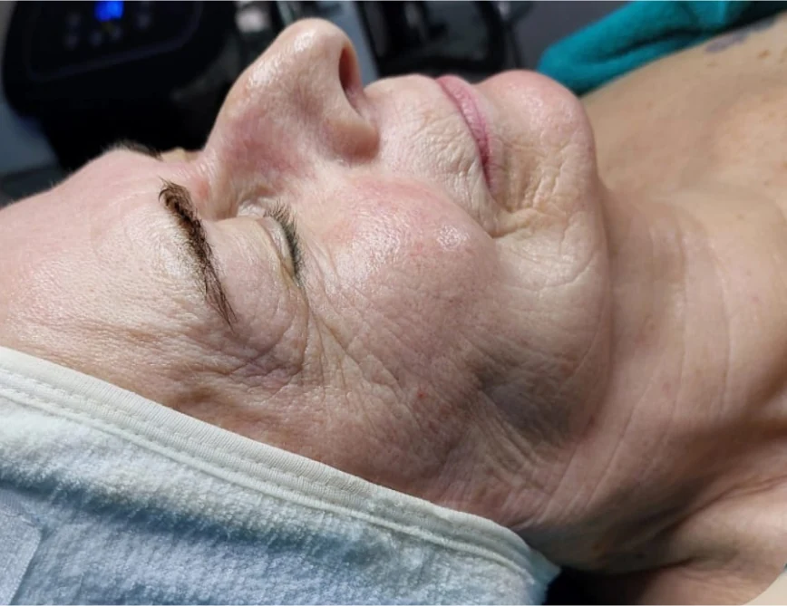 Augen- und Wangenpartie nach der Intra-Skin-Behandlung