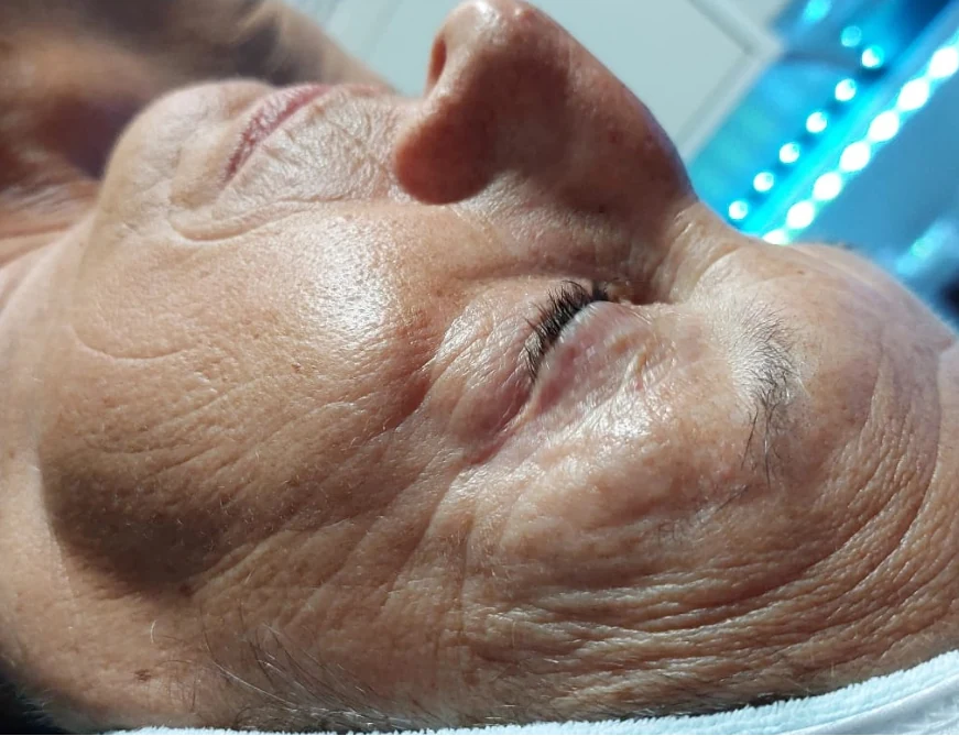 Seitliches Gesichtsprofil vor der Intra-Skin-Behandlung